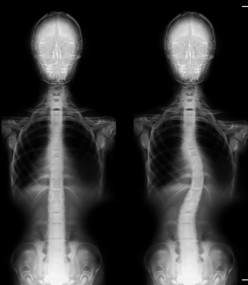 Scoliosis Burnsville